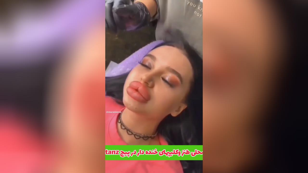 پروتز لب طنزخونه