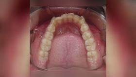اصلاح نامرتبی دندان از دید اکلوزال