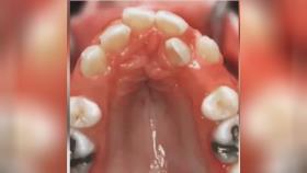 حرکت دندانها با ارتودنسی