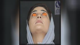 جراح ترمیمی بینی در اصفهان