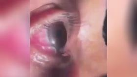 ⭕️ #کژفهمی کرم 15 سانتی درچشم بیمار فیلار یانس که از طرق سگ وگربه خانگی منتقل می