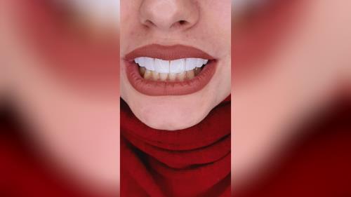 جرمگیری دندان در اصفهان