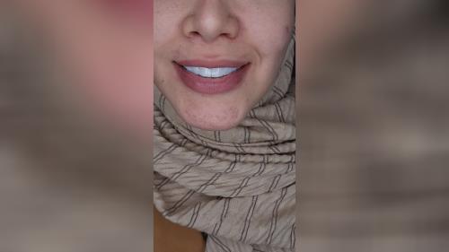 اصلاح طرح لبخند در اصفهان