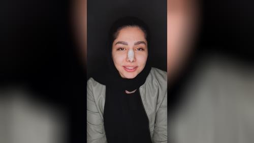 لمینت سرامیکی دندان در اصفهان